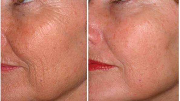 Anti-wrinkle treatment at Alyzah Skin & Beauty