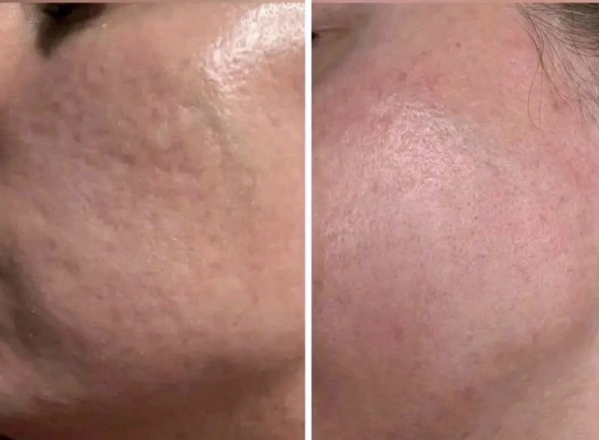 Microneedling client before and after photographs
